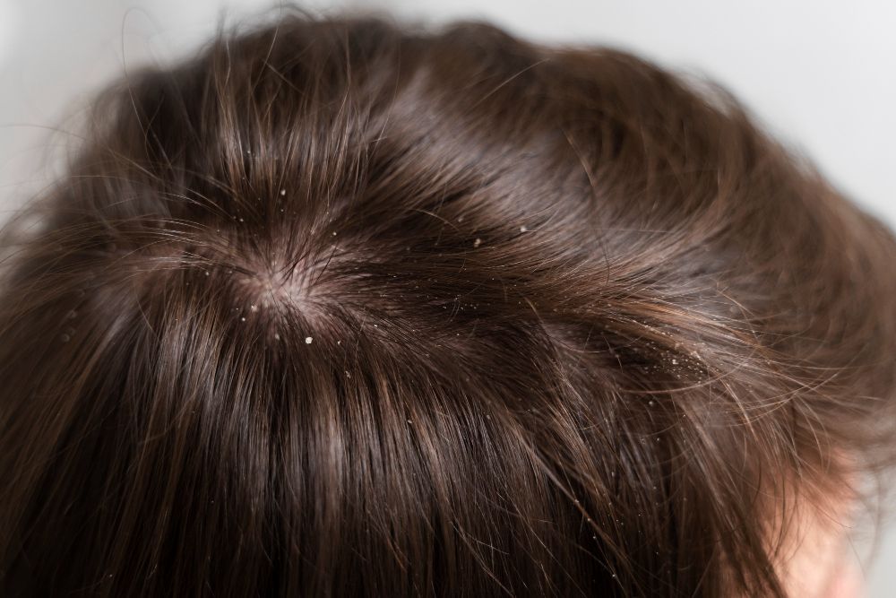 Come risolvere il problema della forfora sui capelli e sulla cute